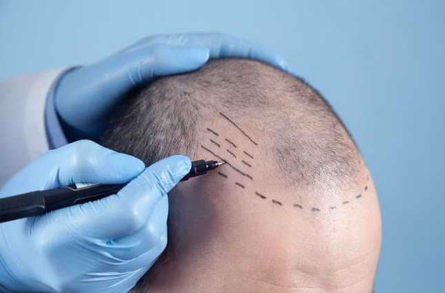 Tahapan Transplantasi Rambut Pria dari Konsultasi hingga Pemulihan