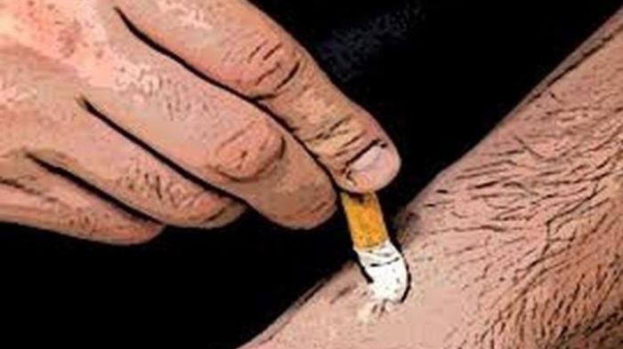 Hati-hati! Dampak Tragis Luka Akibat Sundutan Rokok Jika Tidak Ditangani Cepat