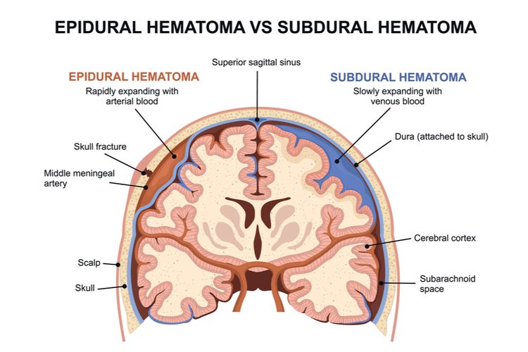 Hematoma Subdural Akut: Penyakit yang Mengguncang Dunia Manga dengan Wafatnya Mangaka Terkenal, Akira Toriyama