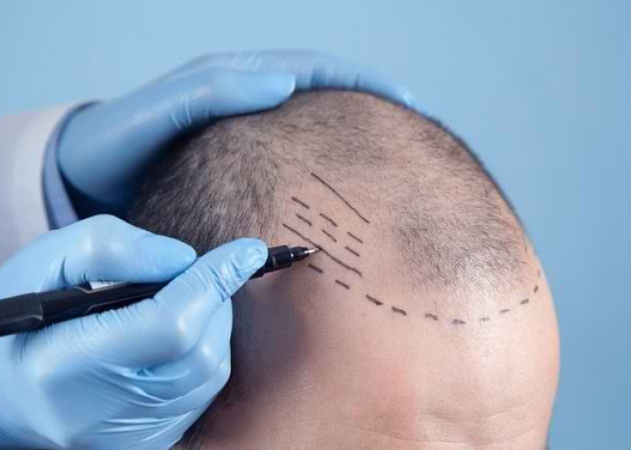 Tahapan Transplantasi Rambut Pria dari Konsultasi hingga Pemulihan