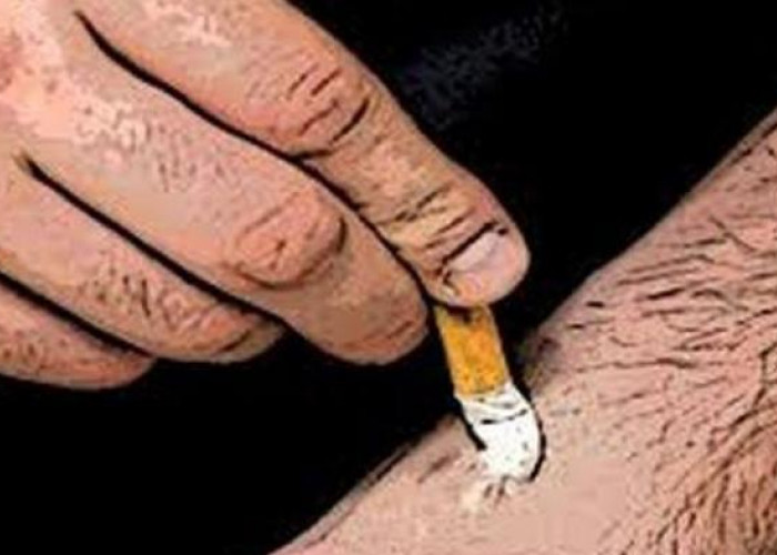 Hati-hati! Dampak Tragis Luka Akibat Sundutan Rokok Jika Tidak Ditangani Cepat