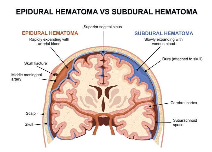 Hematoma Subdural Akut: Penyakit yang Mengguncang Dunia Manga dengan Wafatnya Mangaka Terkenal, Akira Toriyama